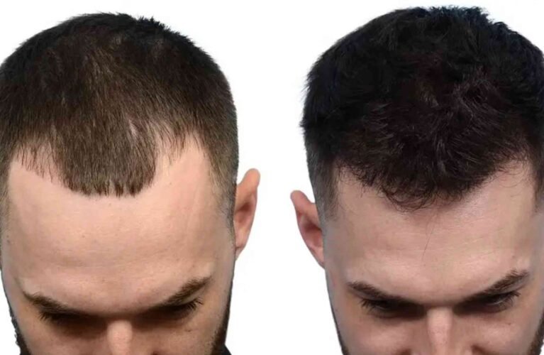 Hair Transplant Turkey